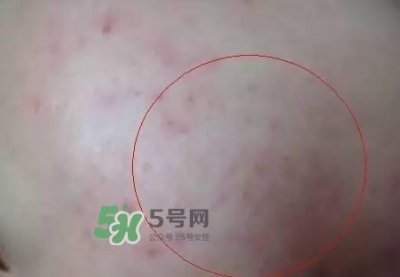 ​红色痘印怎么消除 红色痘印消除小妙招