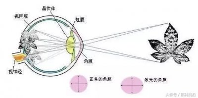 ​散光能自愈吗 散光可以自愈吗