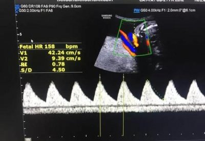 ​胎儿胎心率可以看出男女吗(胎心判断男女准确吗)