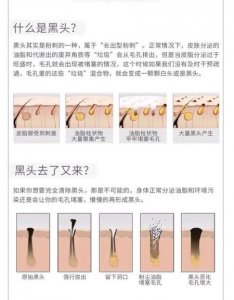 ​如何去黑头用最简单的方法(去黑头小妙招 小偏方)