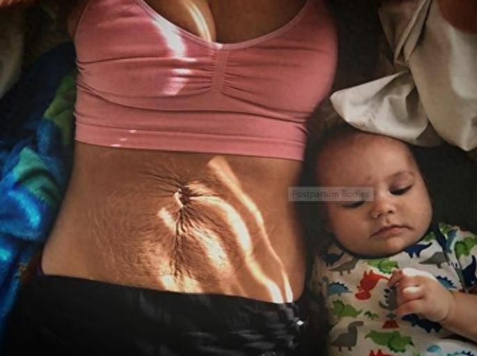 产后妈妈晒肚子上的妊娠纹，赘皮触目惊心，网友却说这很美