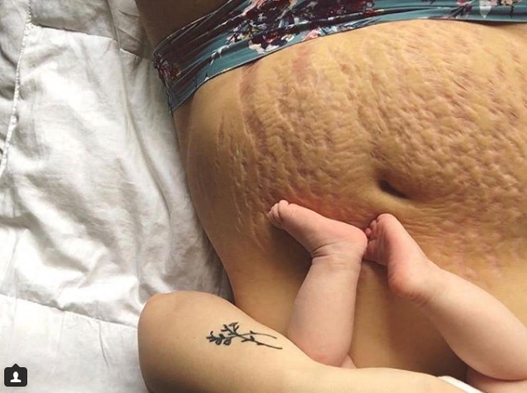 产后妈妈晒肚子上的妊娠纹，赘皮触目惊心，网友却说这很美