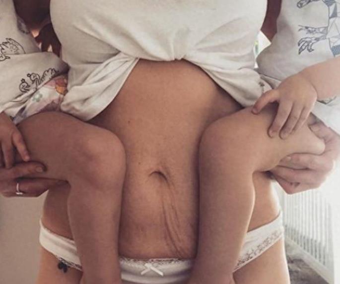 产后妈妈晒肚子上的妊娠纹，赘皮触目惊心，网友却说这很美