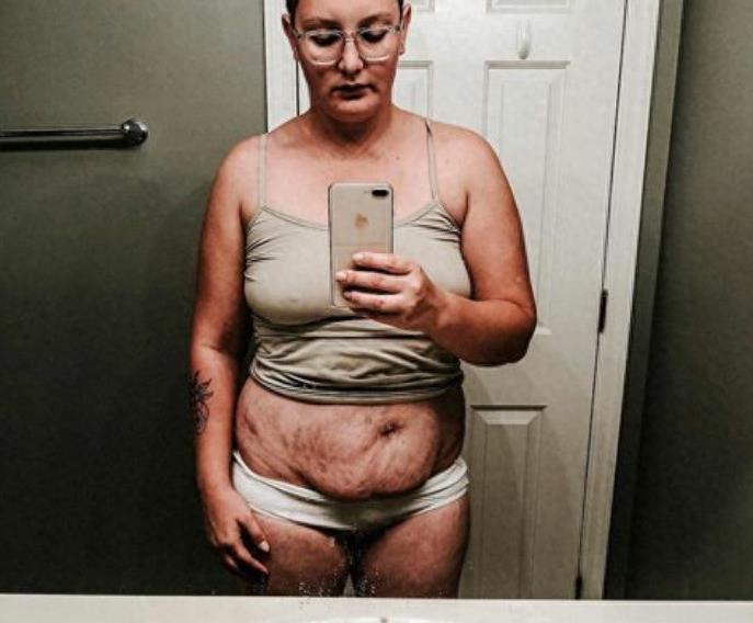 产后妈妈晒肚子上的妊娠纹，赘皮触目惊心，网友却说这很美